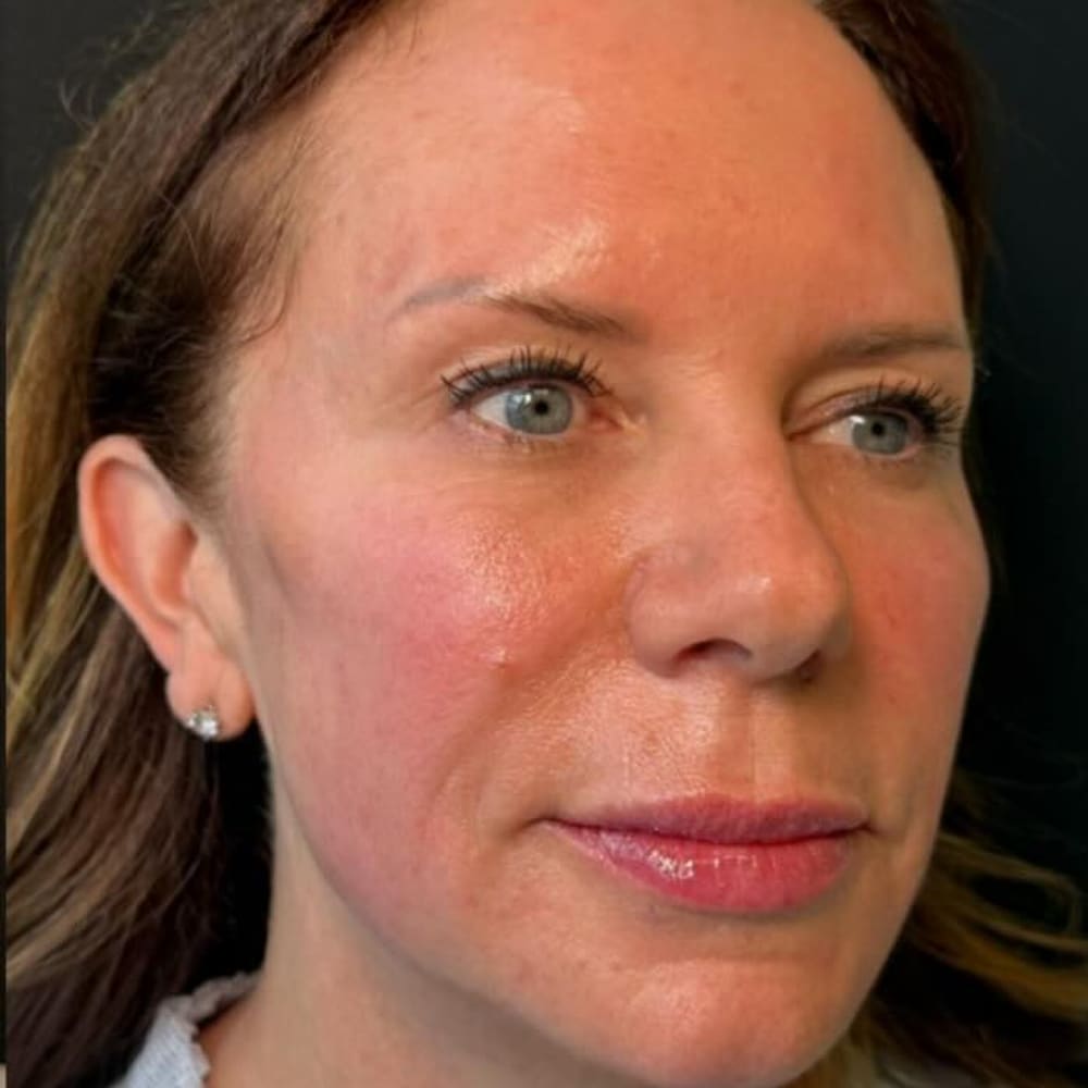 Facial balancing, after treatment