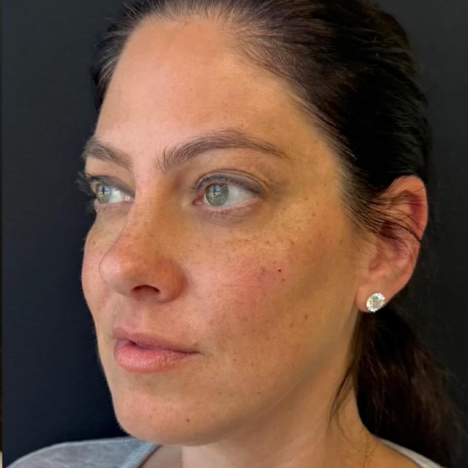 Real patient after cheek filler at ProMD Health Fort Lauderdale, photographed immediately after treatment