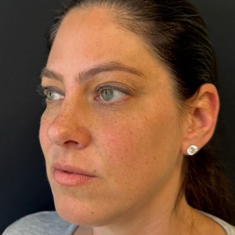 Real patient before cheek filler at ProMD Health Fort Lauderdale
