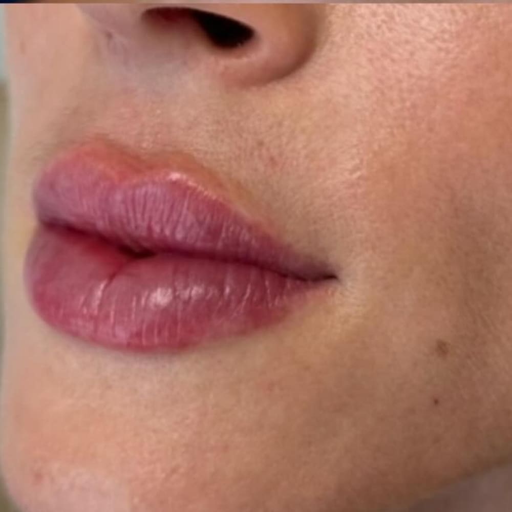 Lip hydration after treatment