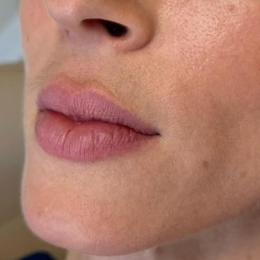 Lip hydration before treatment