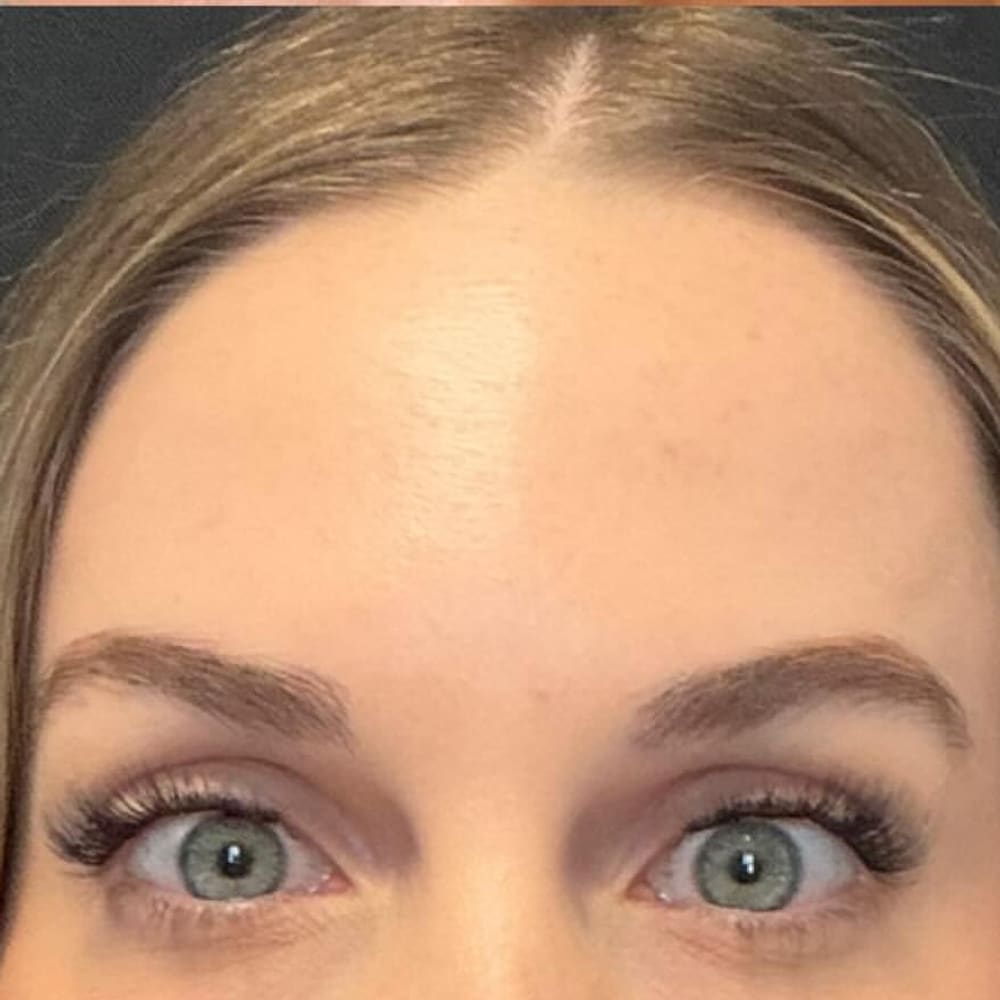 Forehead smoothing after treatment
