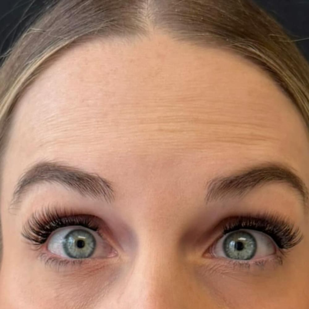Forehead smoothing before treatment