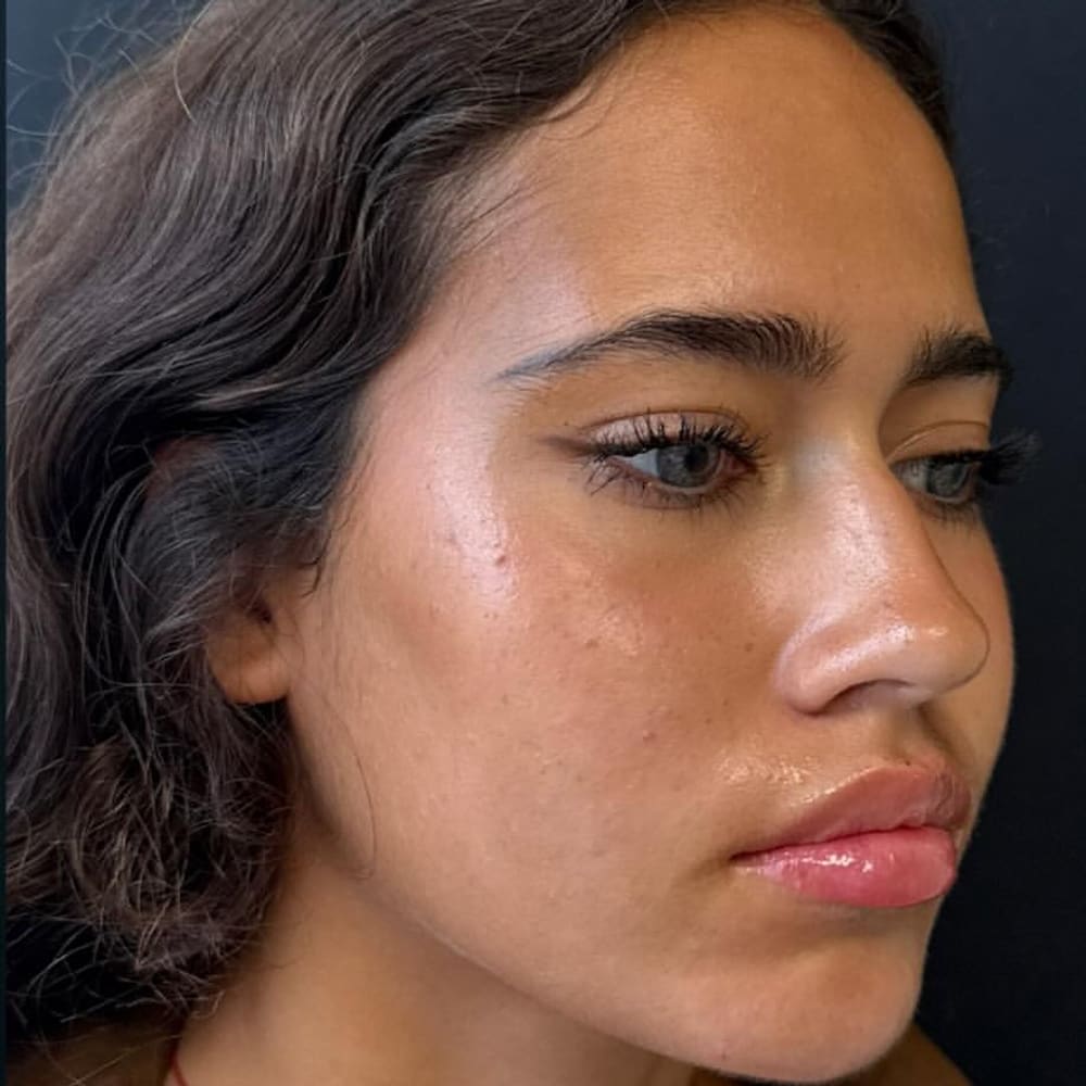 Profile refinement after treatment