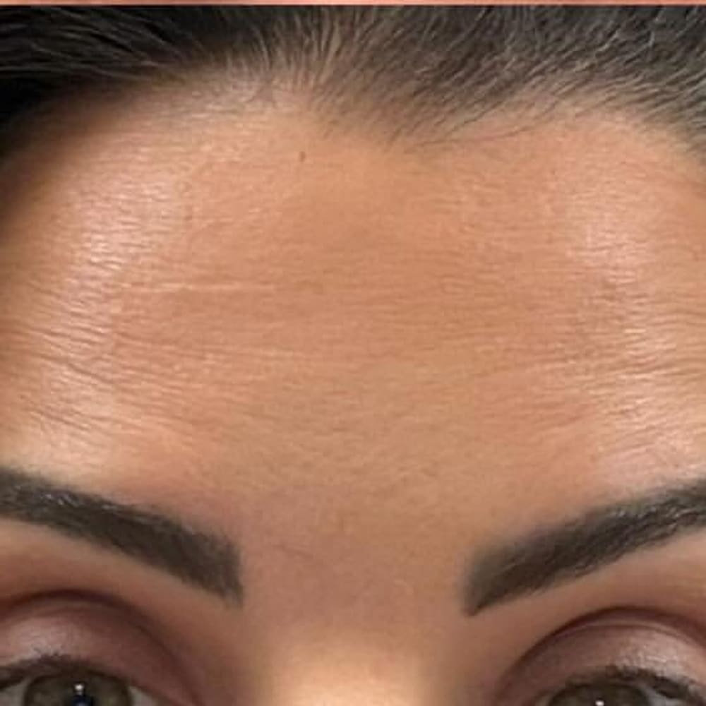 Expression lines after treatment