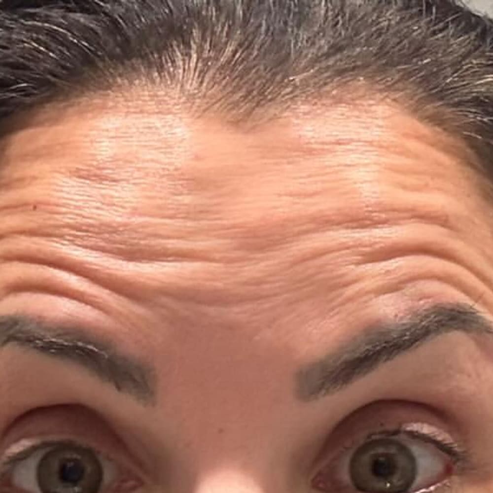 Expression lines before treatment