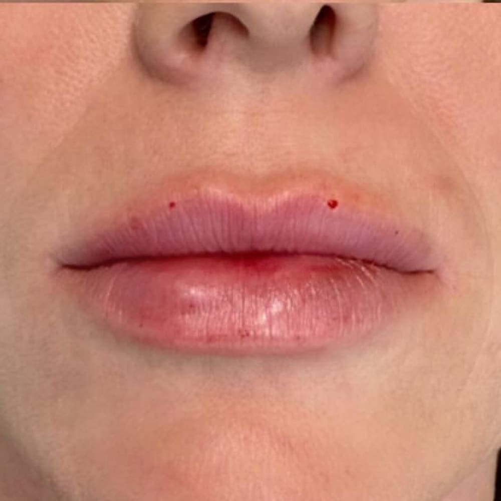 Lip volume after treatment
