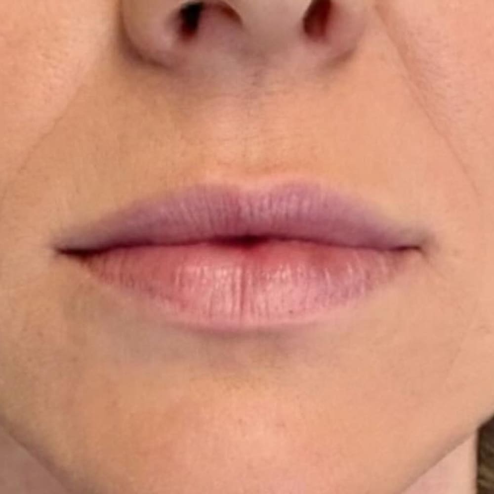 Lip volume before treatment