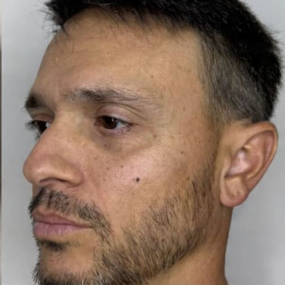 Profile balancing after treatment
