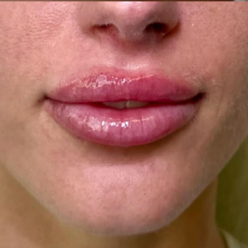 Lip definition after treatment