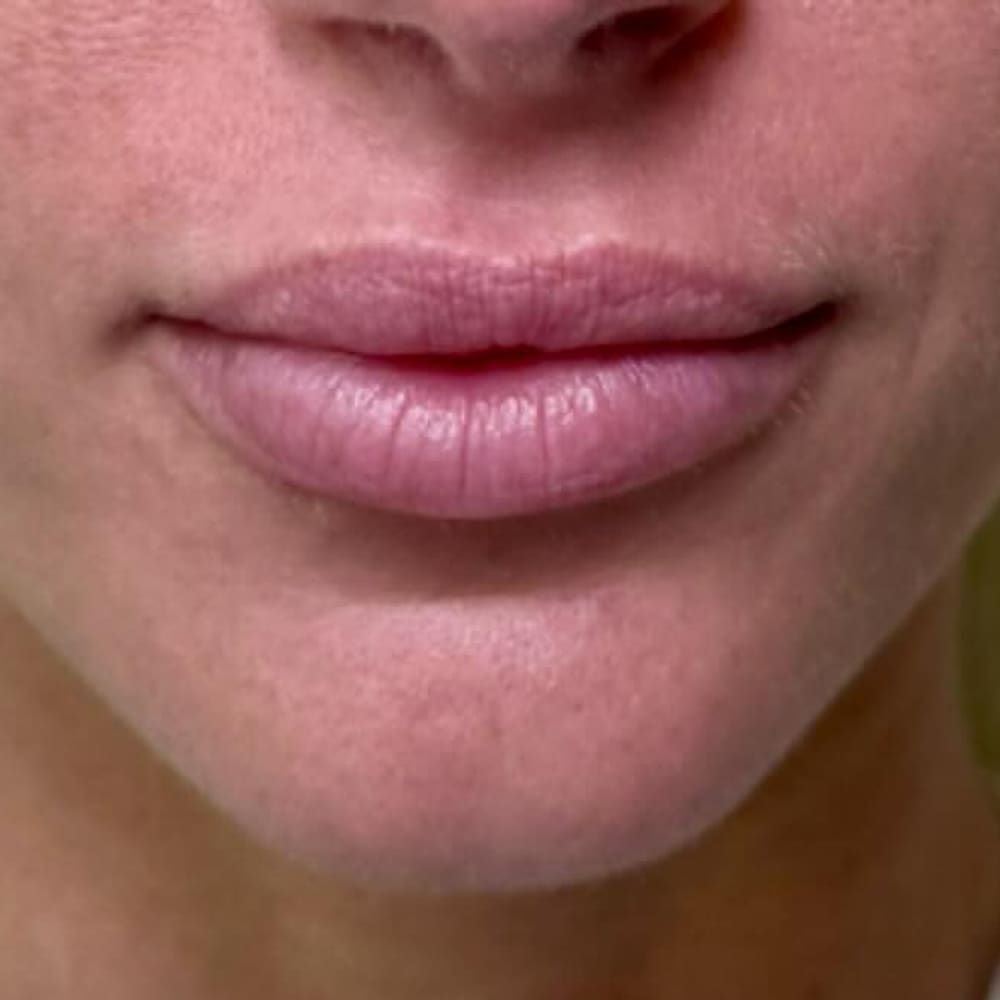 Lip definition before treatment