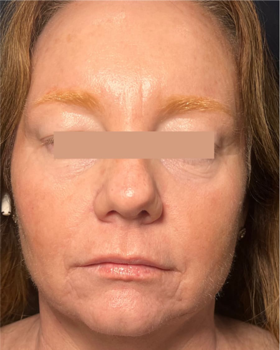 Texture and tone after treatment
