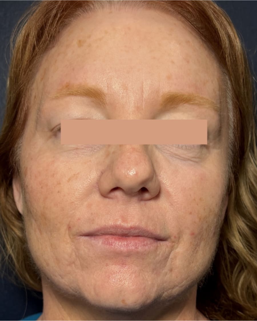 Texture and tone before treatment