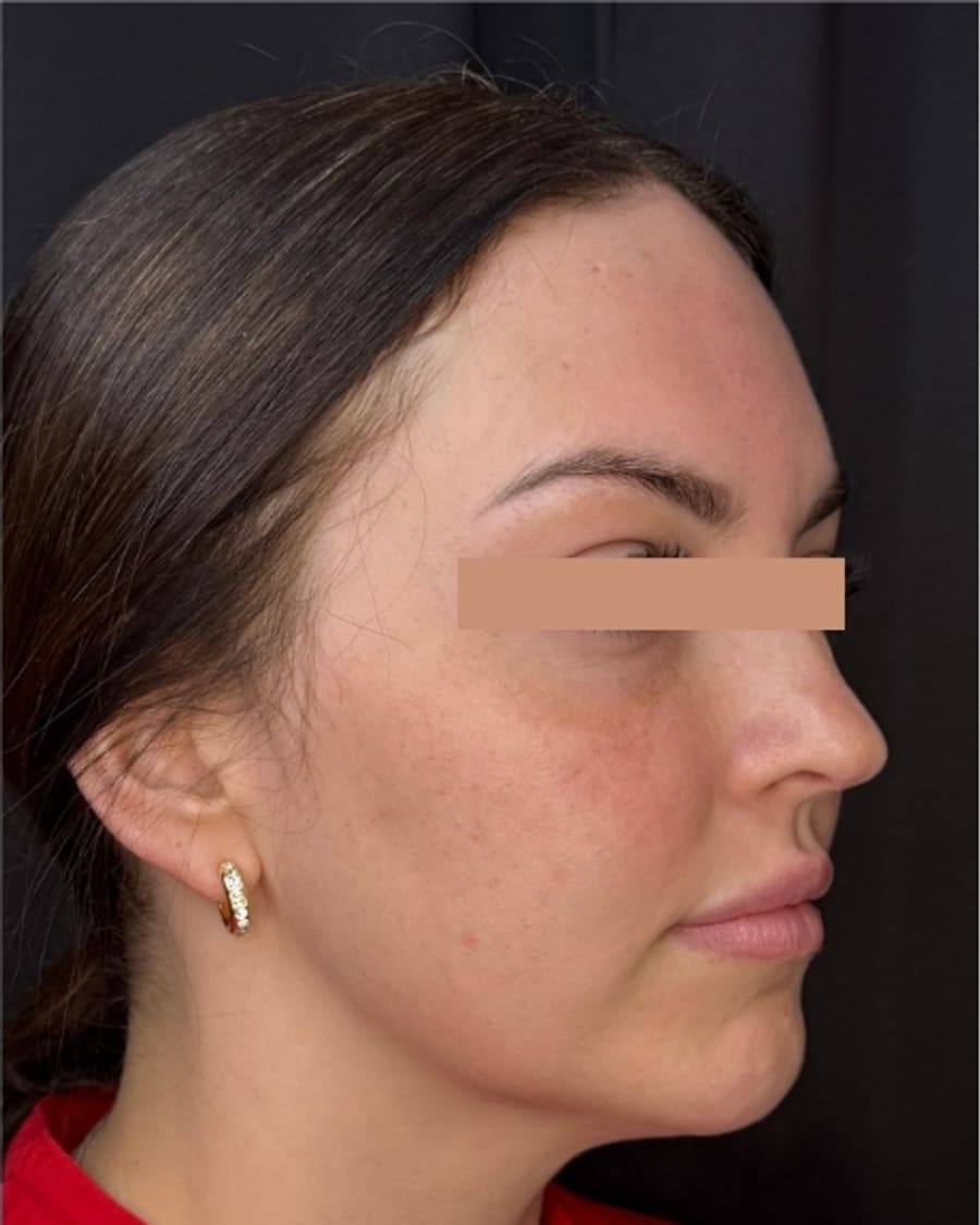 Jawline and texture after treatment