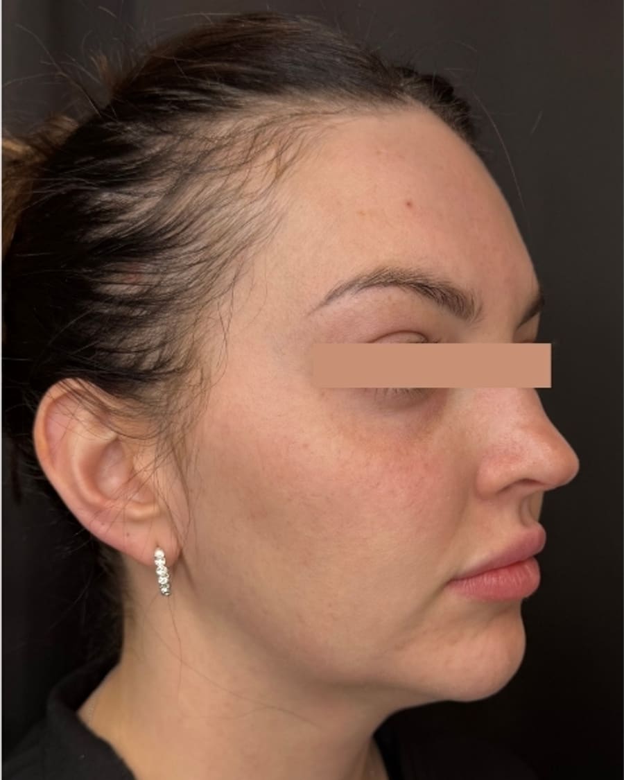 Jawline and texture before treatment