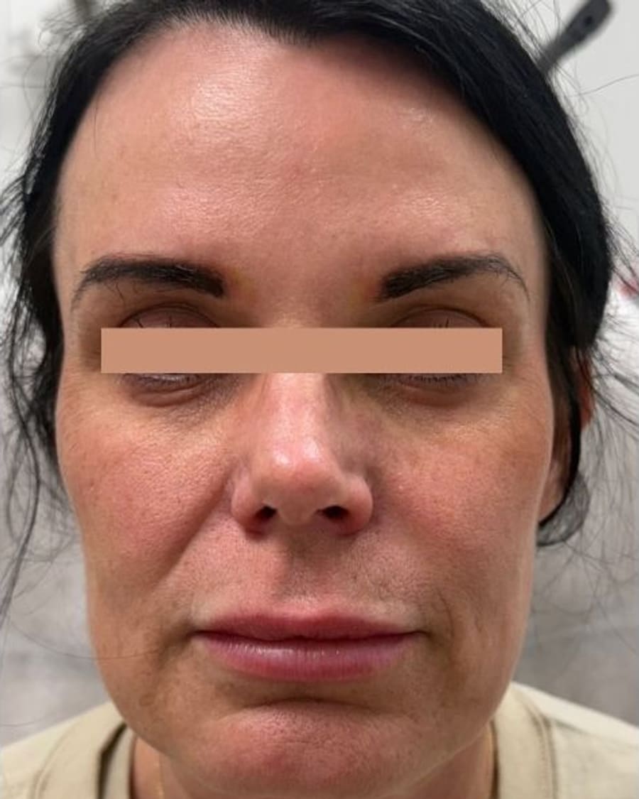 Overall brightness after treatment