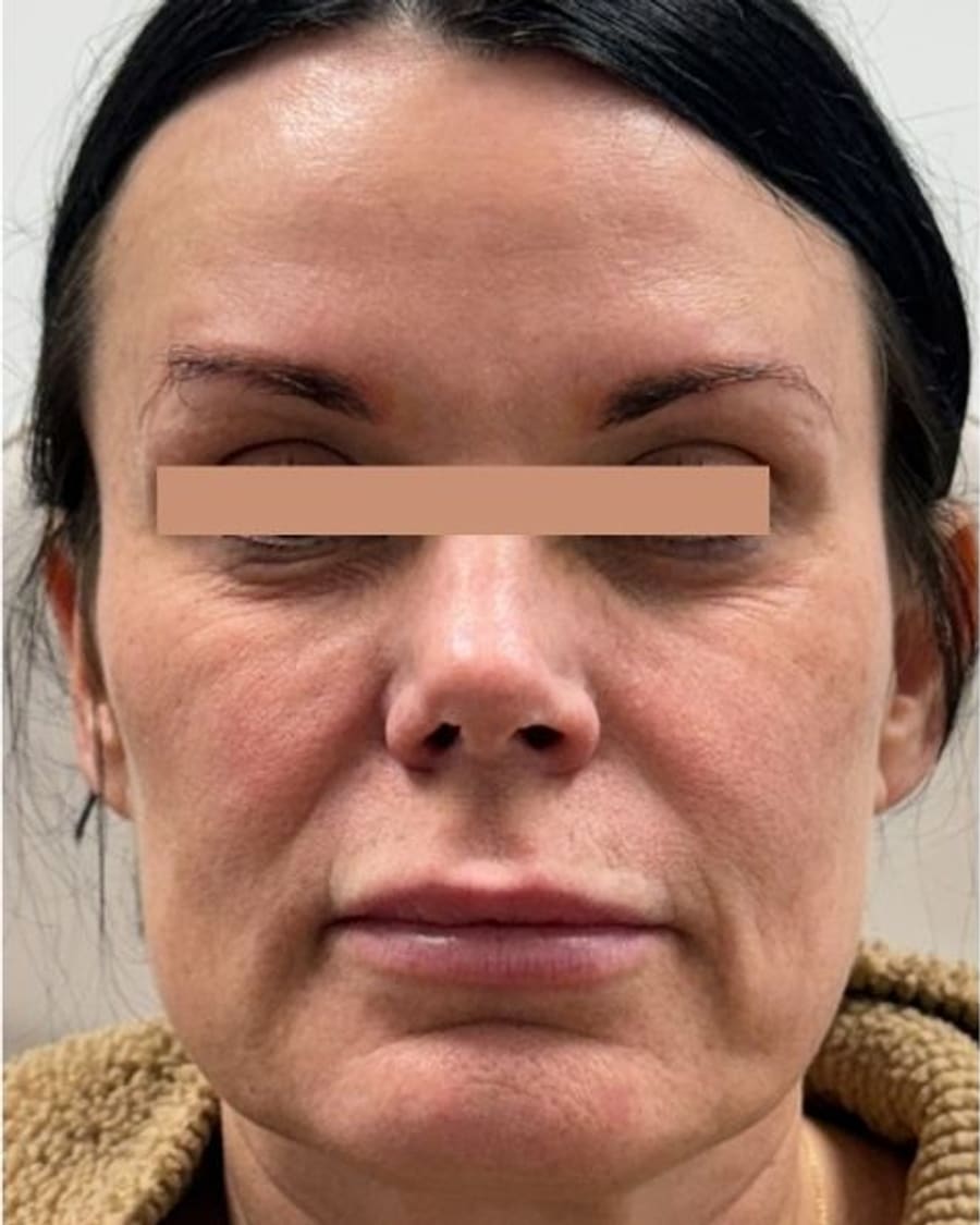 Overall brightness before treatment