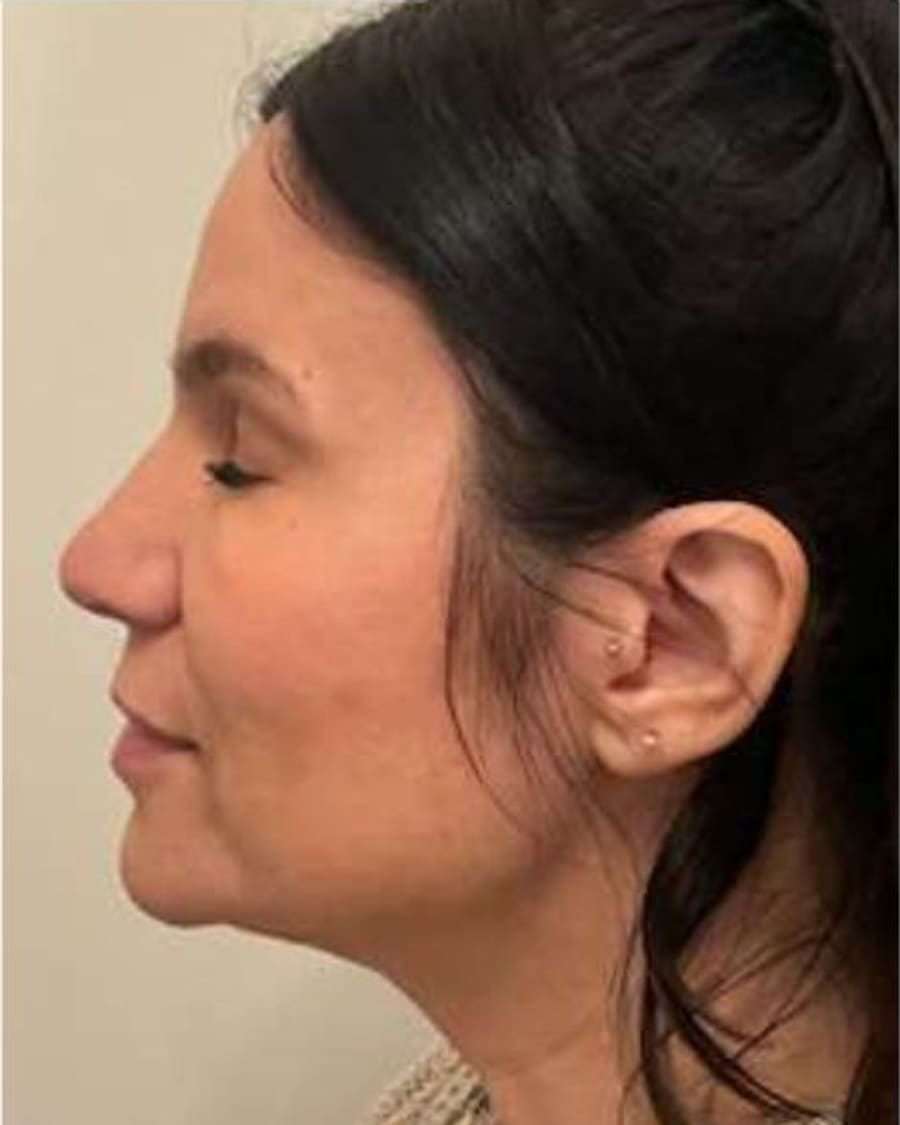 Profile and skin quality after treatment