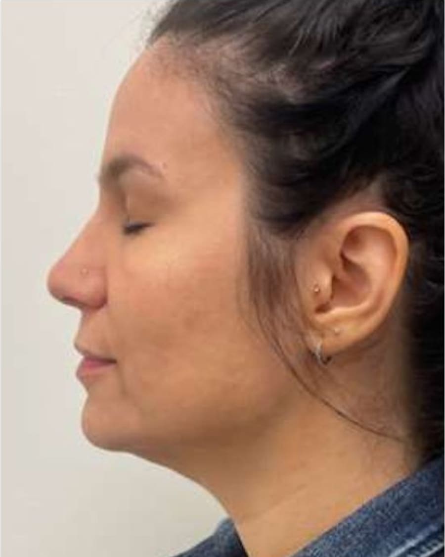 Profile and skin quality before treatment