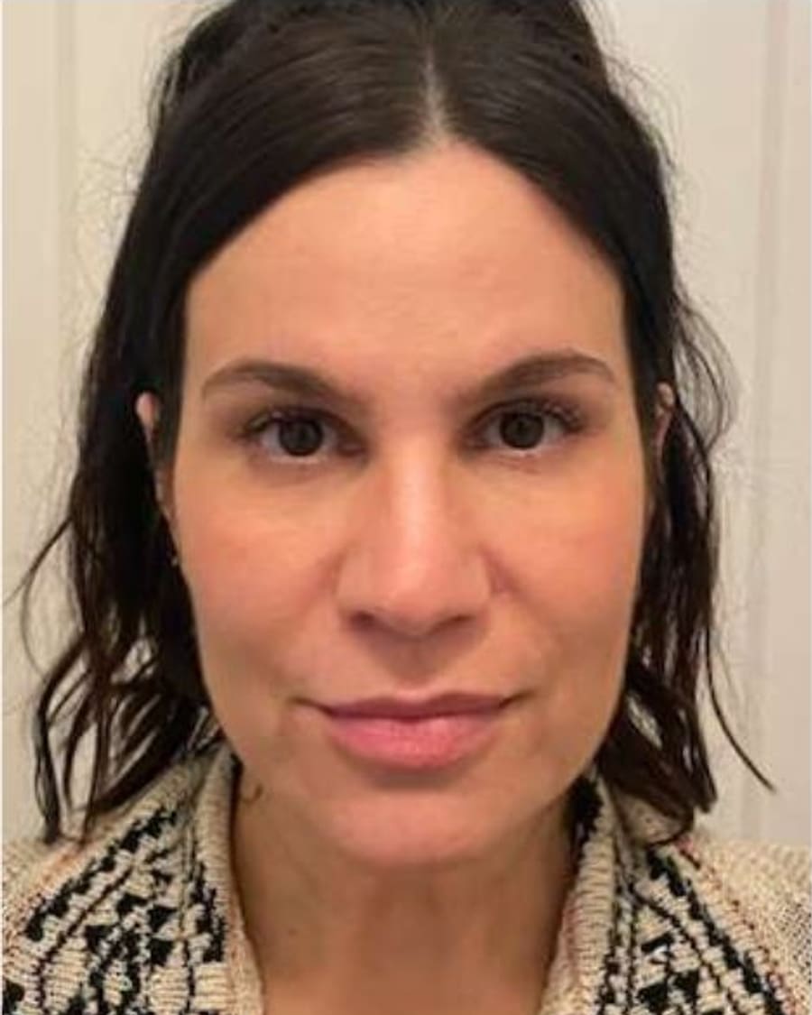 Tone and clarity after treatment