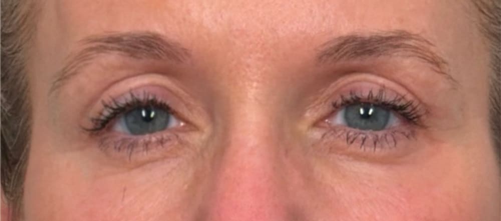 The same periorbital area after one CO₂ treatment and one Deka Fusion treatment — smoother, tighter skin around the eyes