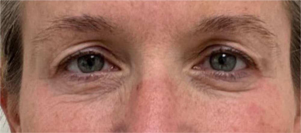 Periorbital skin before CO₂ laser resurfacing — fine lines and crepiness around the eyes