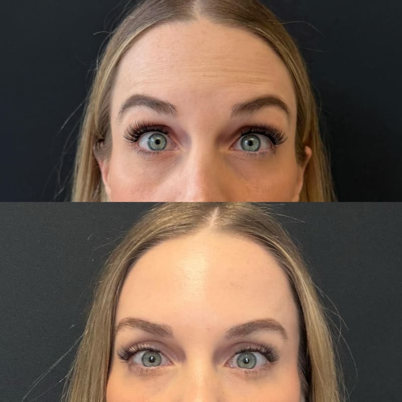 Forehead & crow's feet treatment area