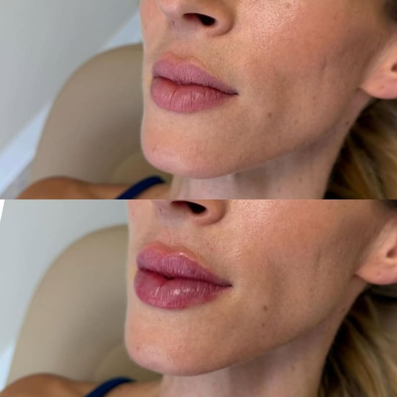 Botox Lip Flip treatment area