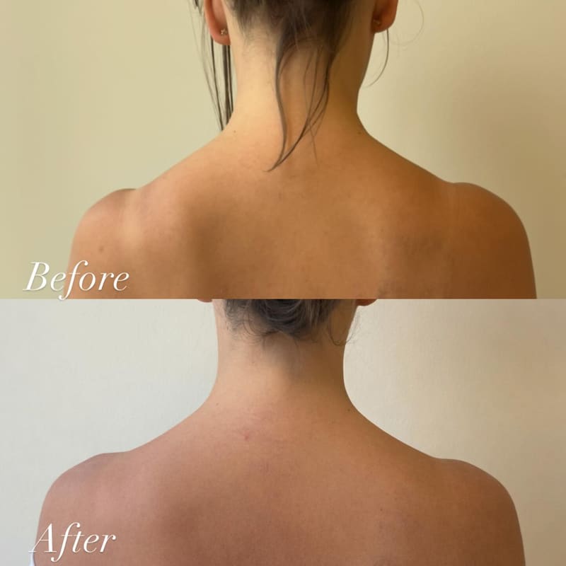 Trap tox / vertical muscle bands treatment area