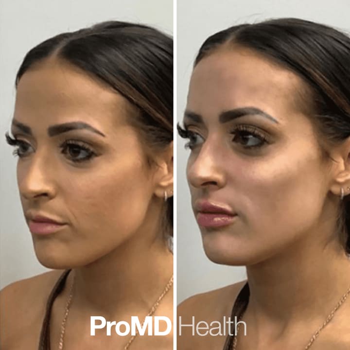 Facials & Chemical Peels at ProMD Health Fort Lauderdale